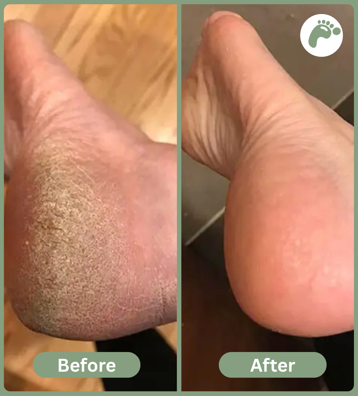 Dermora™ Urea Heel Repair Cream